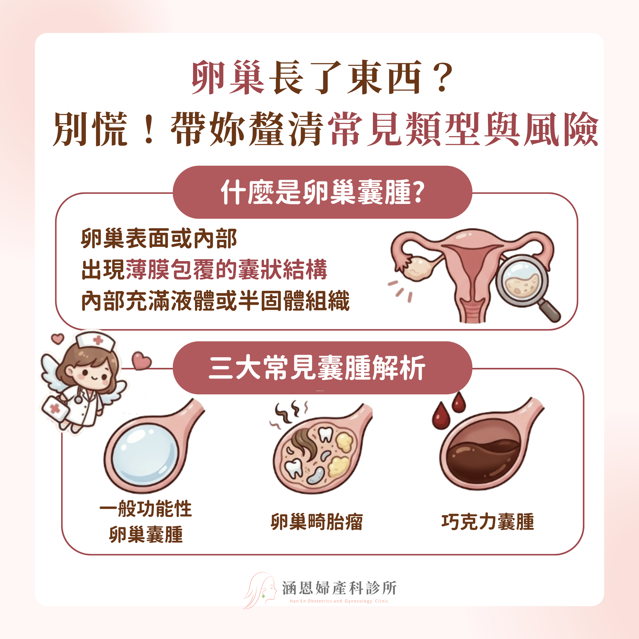 常見卵巢囊腫類型對照：巧克力囊腫（卵巢子宮內膜異位瘤）、功能性囊腫、畸胎瘤與其他卵巢腫塊的成因差異
